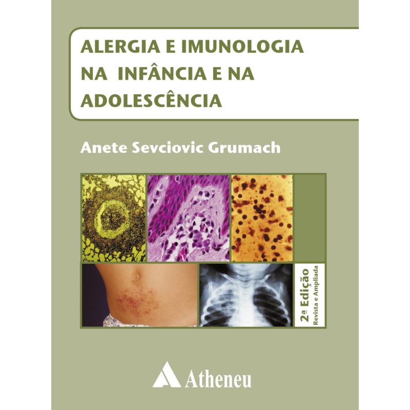 ALERGIA E IMUNOLOGIA NA INFÂNCIA E NA ADOLESCÊNCIA