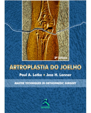 Artroplastia do joelho