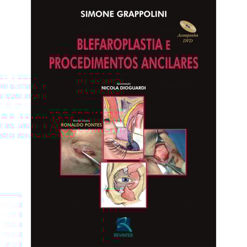BLEFAROPLASTIA E PROCEDIMENTOS ANCILARES