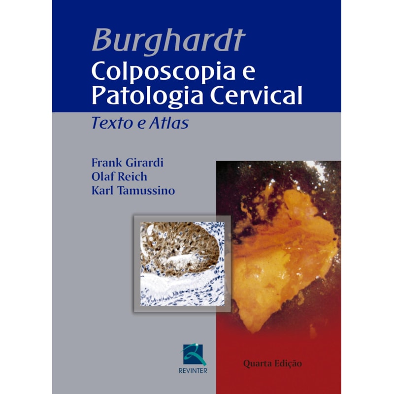 Burghardt - Colposcopia e Patologia Cervical: Texto e Atlas