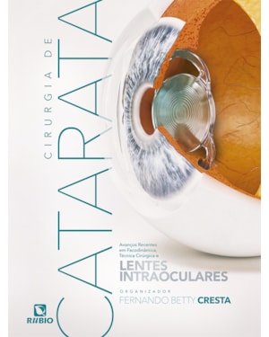 Cirurgia de Catarata: Avanços Recentes em Facodinâmica, Técnica Cirúrgica e Lentes Intraoculares