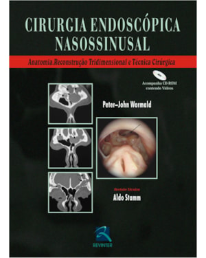 Cirurgia endoscópica nasossinusal