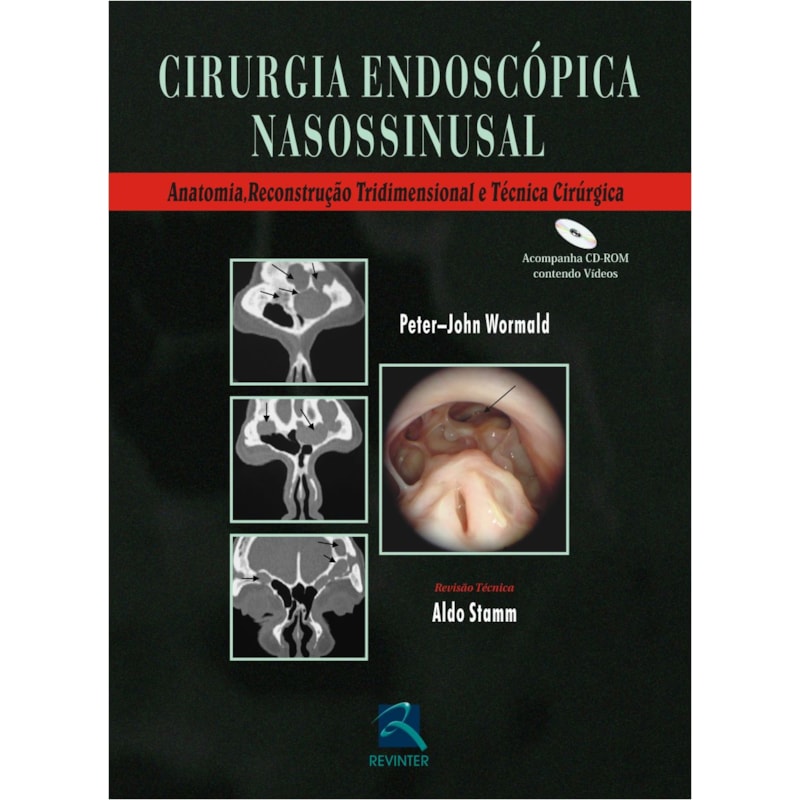 Cirurgia endoscópica nasossinusal