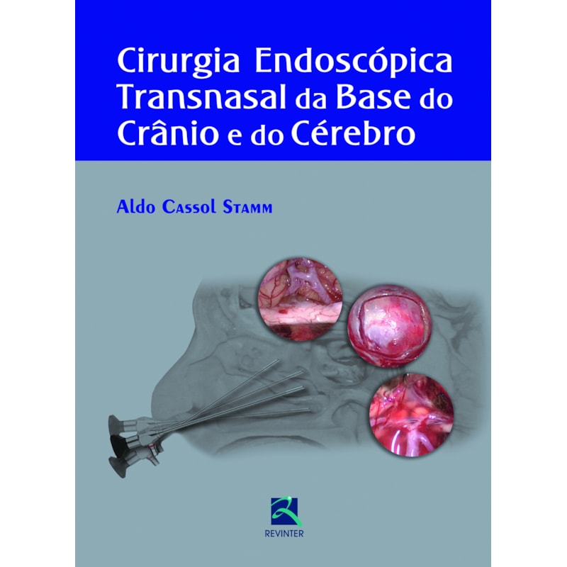 Cirurgia endoscópica transnasal da base do crânio e do cérebro