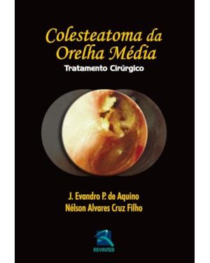 Colesteatoma da orelha média: tratatamento cirúrgico