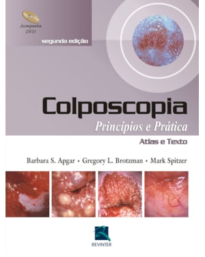 Colposcopia: princípios e prática