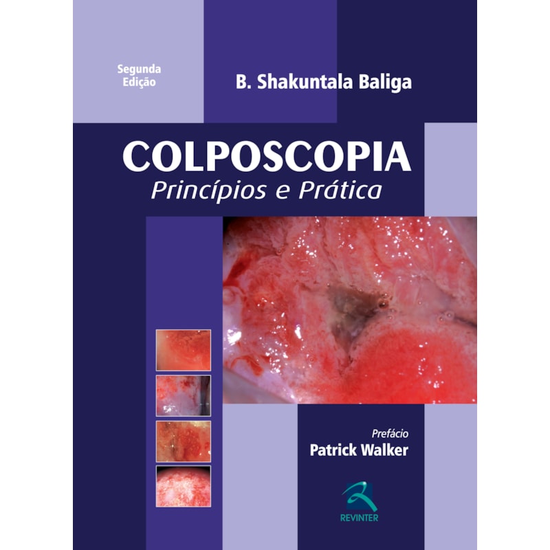 COLPOSCOPIA: PRINCÍPIOS E PRÁTICA