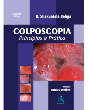 Colposcopia: princípios e prática