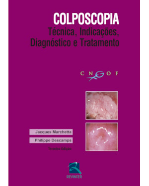 Colposcopia: Técnica, Indicações, Diagnóstico e Tratamento