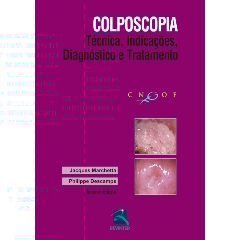 COLPOSCOPIA: TÉCNICA, INDICAÇÕES, DIAGNÓSTICO E TRATAMENTO