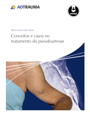 CONCEITOS E CASOS NO TRATAMENTO DA PSEUDOARTROSE