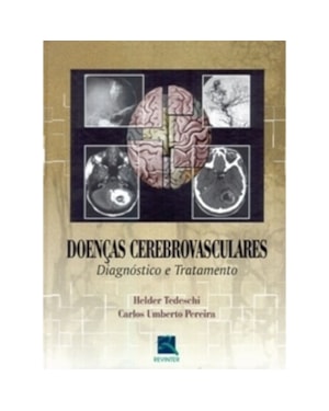 DOENÇAS CEREBROVASCULARES: DIAGNÓSTICO E TRATAMENTO