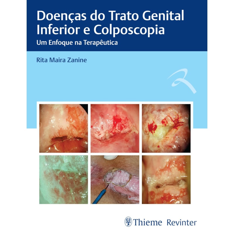 DOENÇAS DO TRATO GENITAL INFERIOR E COLPOSCOPIA: UM ENFOQUE NA TERAPÊUTICA