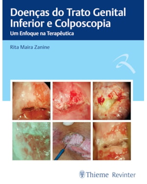 Doenças do trato genital inferior e colposcopia: um enfoque na terapêutica