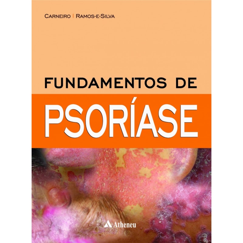 FUNDAMENTOS DE PSORÍASE
