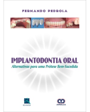 Implantodontia oral: alternativas para uma prótese bem-sucedida