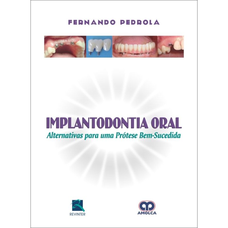 Implantodontia oral: alternativas para uma prótese bem-sucedida
