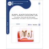 IMPLANTODONTIA: PRINCÍPIOS, TÉCNICAS DE FABRICAÇÃO, REABILITAÇÃO, OCLUSÃO E TIPOS DE PRÓTESES