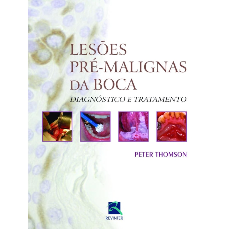 Lesões pré-malignas da boca: diagnóstico e tratamento