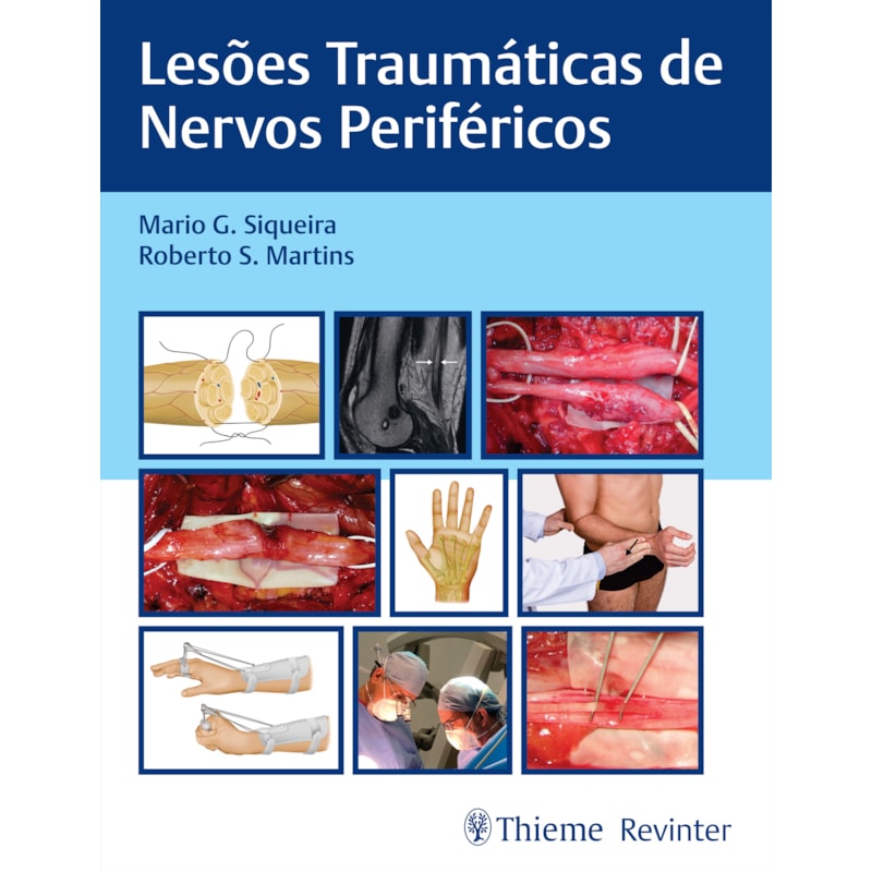 LESÕES TRAUMÁTICAS DE NERVOS PERIFÉRICOS