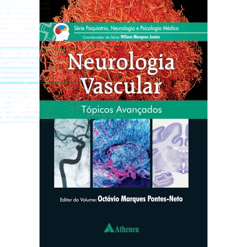 NEUROLOGIA VASCULAR: TÓPICOS AVANÇADOS