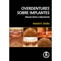 OVERDENTURES SOBRE IMPLANTES: MANUAL CLÍNICO E LABORATORIAL