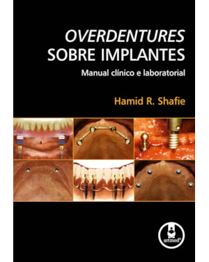 OVERDENTURES SOBRE IMPLANTES: MANUAL CLÍNICO E LABORATORIAL