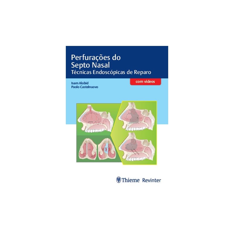 PERFURAÇÕES DO SEPTO NASAL: TÉCNICAS ENDOSCÓPICAS DE REPARO