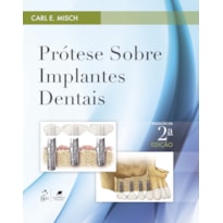 PRÓTESE SOBRE IMPLANTES DENTAIS