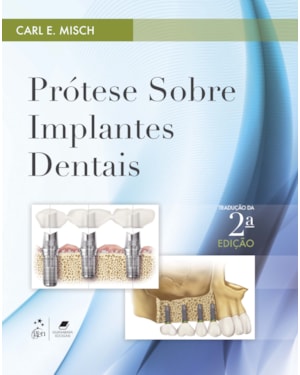 PRÓTESE SOBRE IMPLANTES DENTAIS