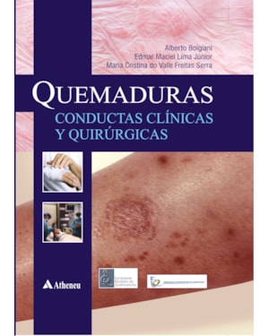 Quemaduras - Conductas clínicas y quirúrgicas
