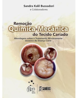 REMOÇÃO QUÍMICA E MECÂNICA DO TECIDO CARIADO