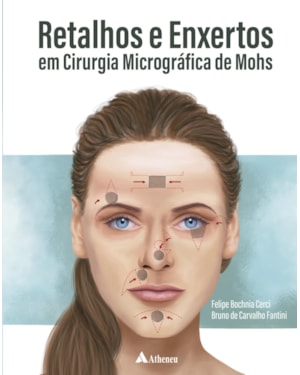 Retalhos e enxertos em cirurgia micrográfica de Mohs