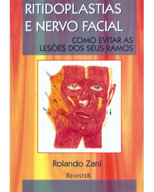 RITIDOPLASTIAS E NERVO FACIAL
