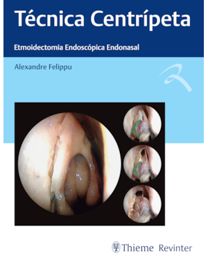 Técnica centrípeta: etmoidectomia endoscópica endonasal