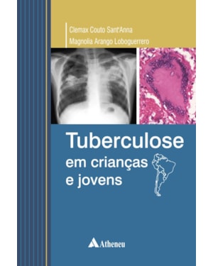 Tuberculose em criancas e jovens