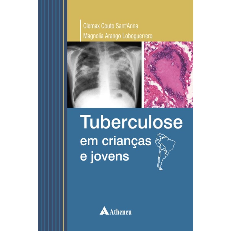 TUBERCULOSE EM CRIANÇAS E JOVENS