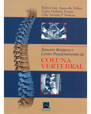 Tumores benignos e lesões pseudotumorais da coluna vertebral