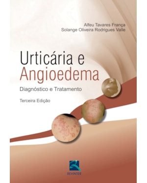 Urticária e angiodema: diagnóstico e tratamento